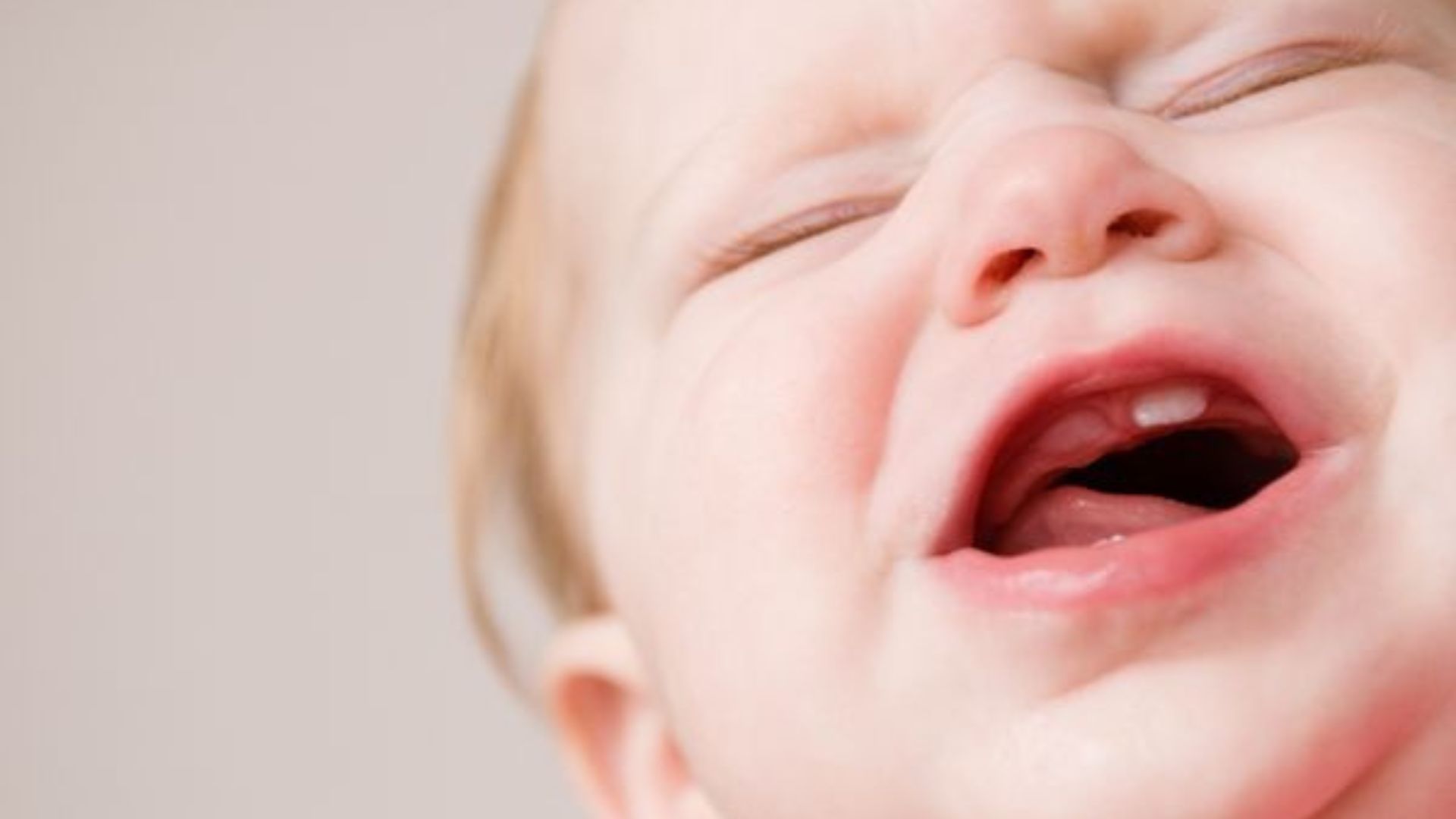 Các dạng thiếu mầm răng ở các bé