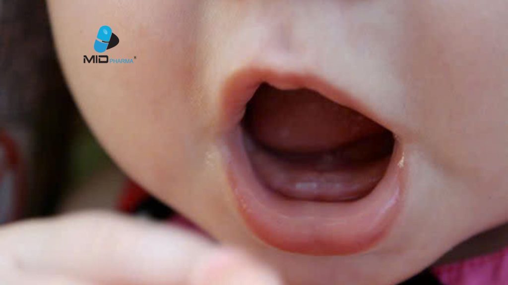 Các dạng thiếu mầm răng ở trẻ